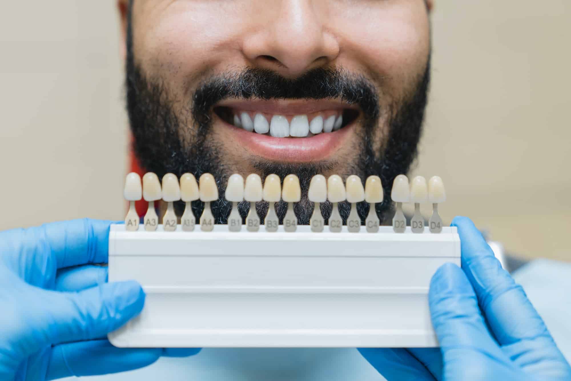 Dental care, implants for veneers. Man with perfect smile choosing teeth tooth tone at dental clinic