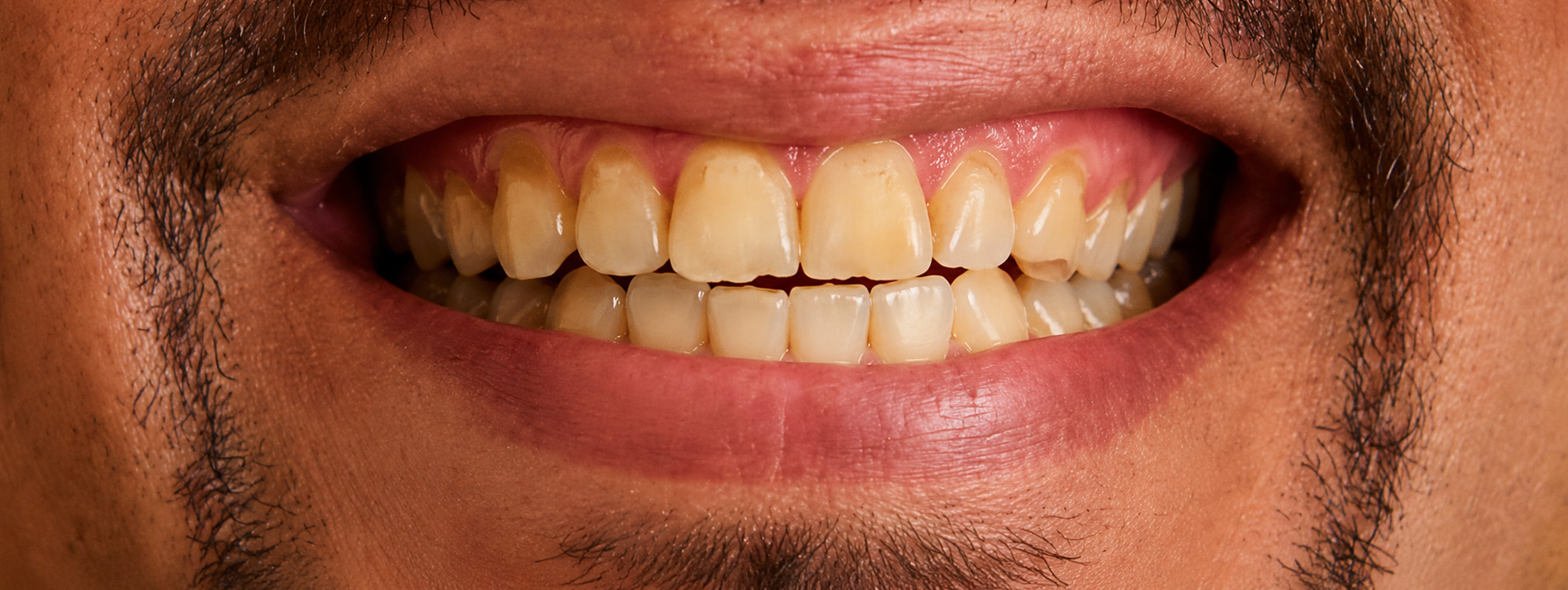 smile-sample-1-before smile-sample-1-before