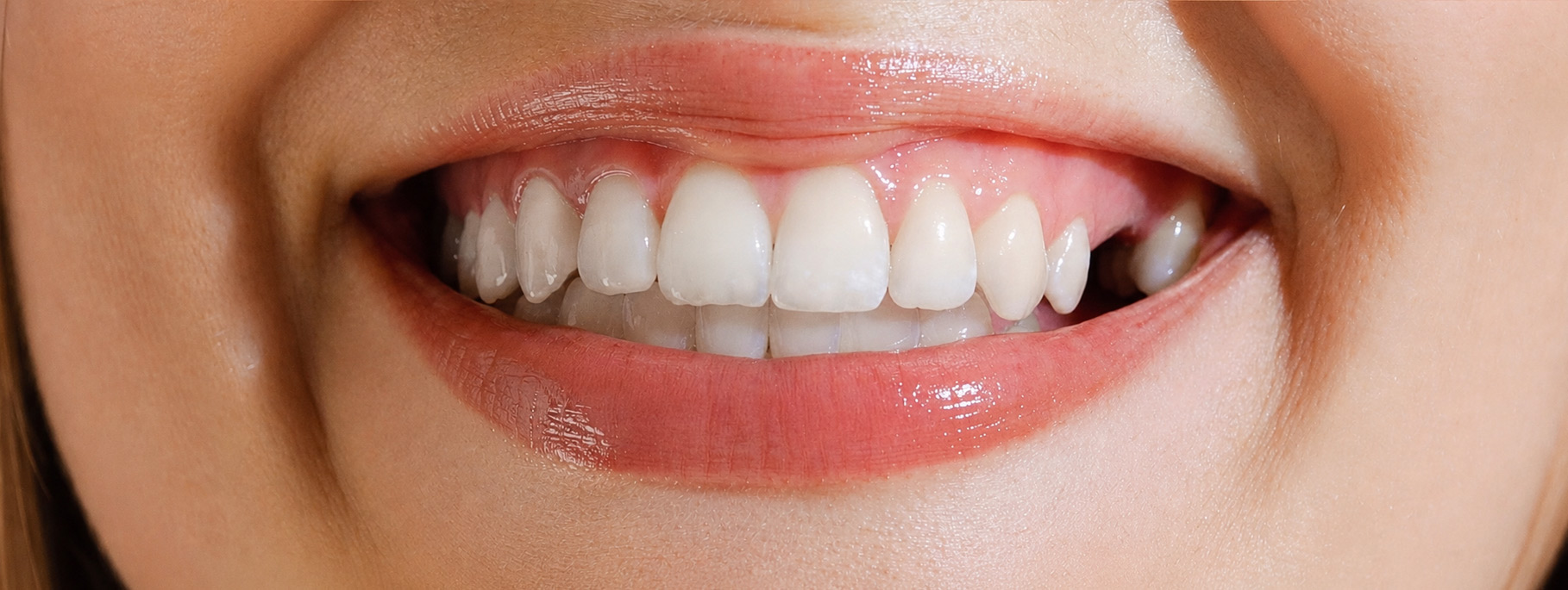 smile-sample-4-before smile-sample-4-before