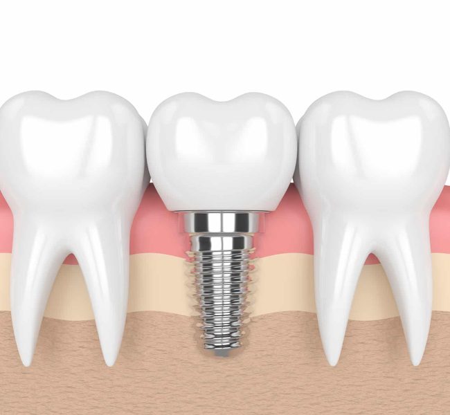 reasons-for-dental-implants